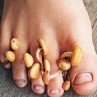 Грибковые заболевания ногтей человека (онихомикозы)